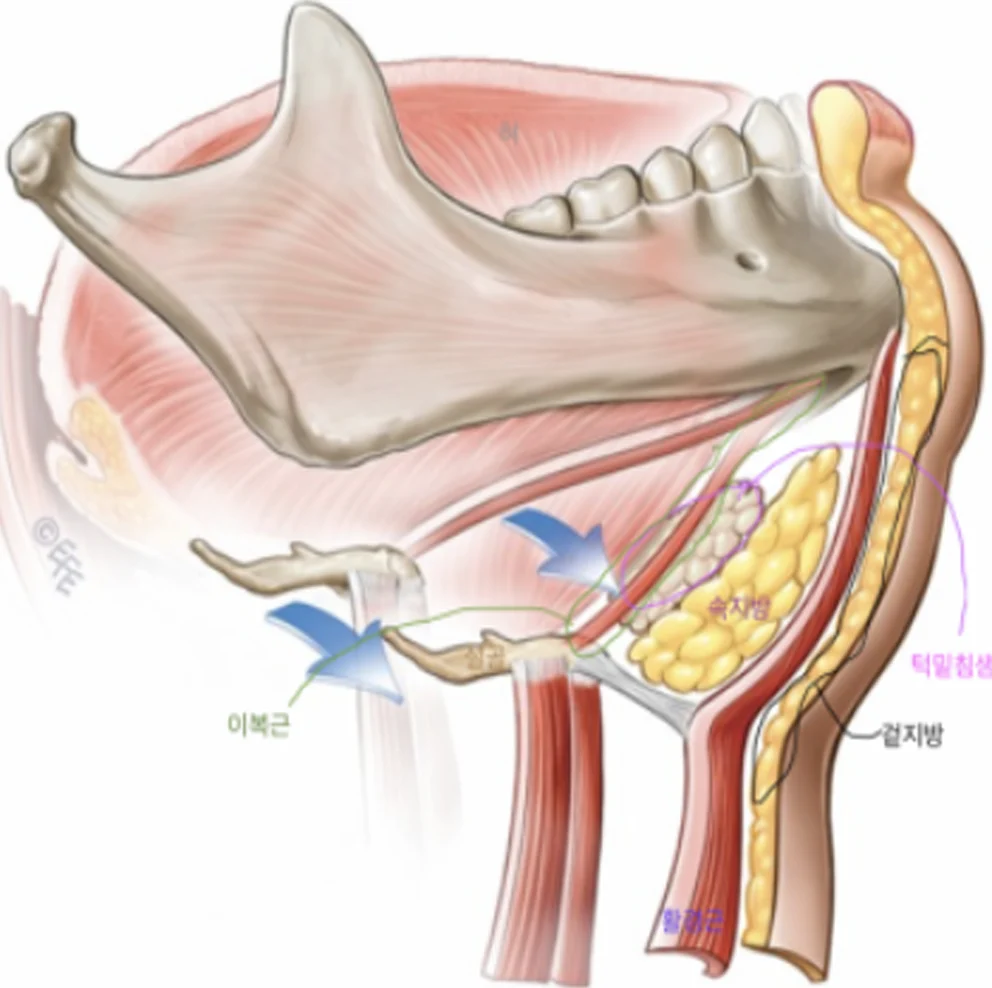 이중턱3